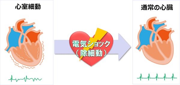 心室細動に電気ショック（除細動）をして、通常の心臓へ