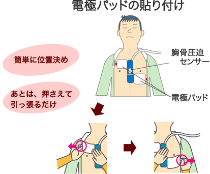 電極パッドの貼り付け「簡単に位置決め」「あとは、押さえて引っ張るだけ」